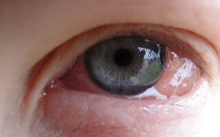 Причины и лечение отека глазного яблока