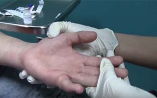 Основные причины и методы лечения опухших суставов пальцев на руке