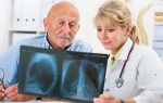 Лечение и прогноз выздоровления застойной пневмонии у пожилых людей