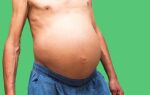 Основные признаки и методы лечения асцита брюшной полости
