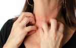 Причины, симптомы и лечение аллергического отека гортани