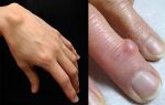 Причины образования шишек на пальцах рук и способы лечения