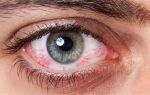 Как лечить макулярный отек сетчатки глаза