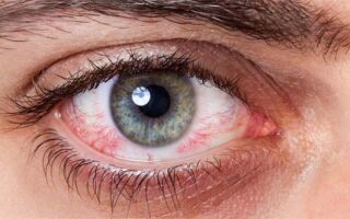 Как лечить макулярный отек сетчатки глаза