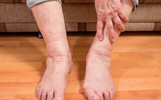 Почему у пожилых женщин отекают ноги, причины и лечение