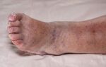 Причины и лечение отечности, посинения ног у пожилого человека