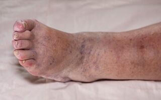 Причины и лечение отечности, посинения ног у пожилого человека