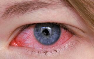 Основные причины, симптомы и методы лечения отека диска зрительного нерва