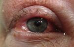Лечение отека роговицы глаза после операции катаракты и замены хрусталика
