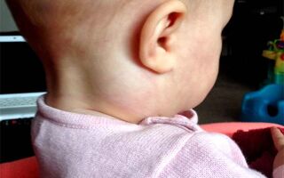 Причины воспаление у ребенка лимфоузла за ухом и что делать с шишкой