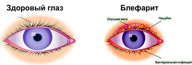 Блефарит и здоровый глаз