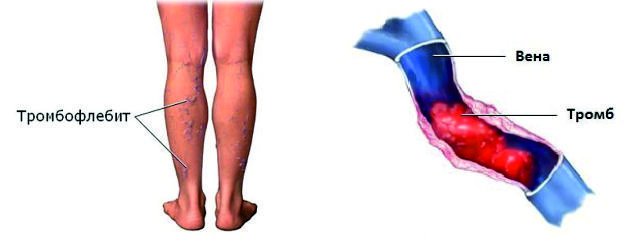 Пример тромбофлебита на ноге