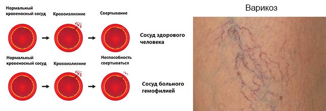 Гемофилия и варикоз