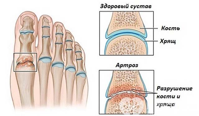 Как вылечить опухоль на пальце ноги при thumbnail