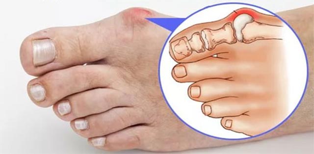 Опухает палец на ноге причины лечение thumbnail