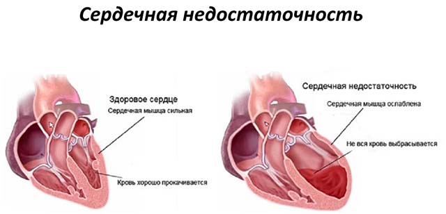 Сердечные заболевания