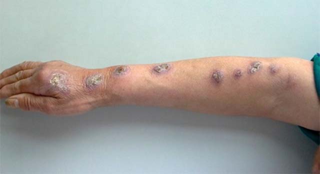 Инфекционные поражения кожи