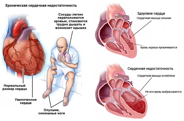 Патология сердца