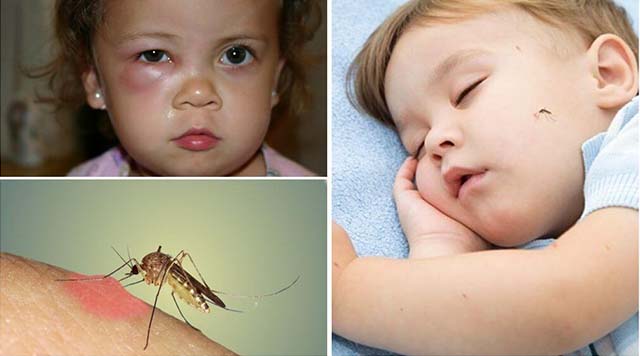 Как избавится от отека на глазу укус комара thumbnail