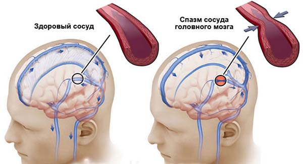 Спазм сосудов головного мозга