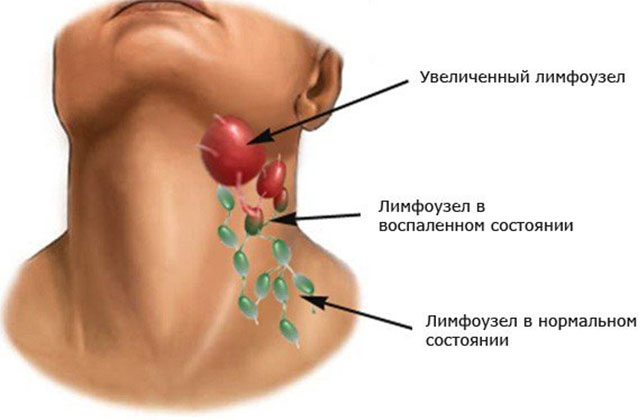 Пример воспаленного и нормального лимфоузла