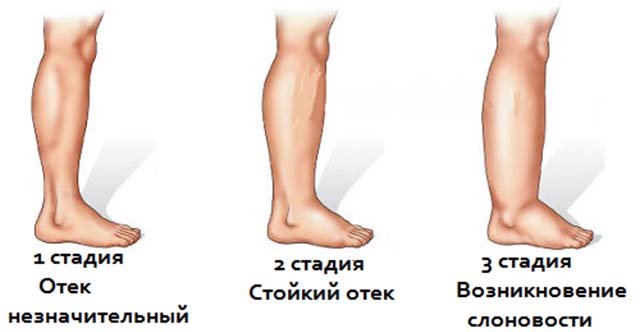 Лимфостаз нижних конечностей симптомы фото и лечение