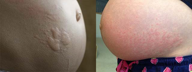 Отеки ног при беременности на поздних сроках лечение народными средствами thumbnail