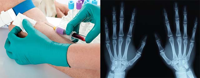 Забор крови и рентгенография рук