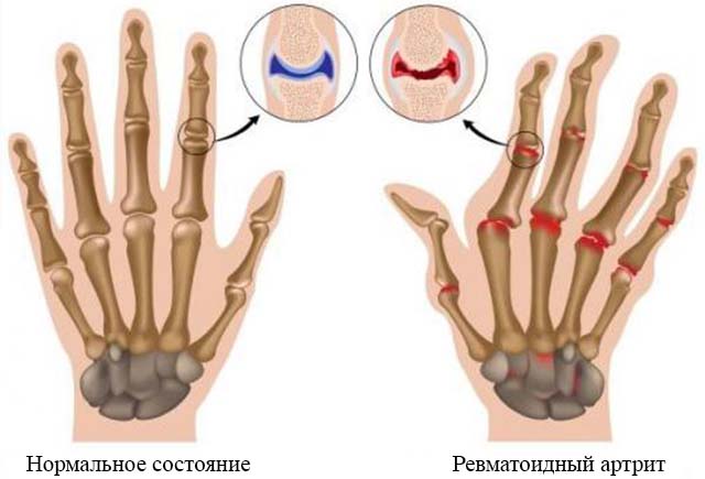 Опух палец на руке лечение thumbnail