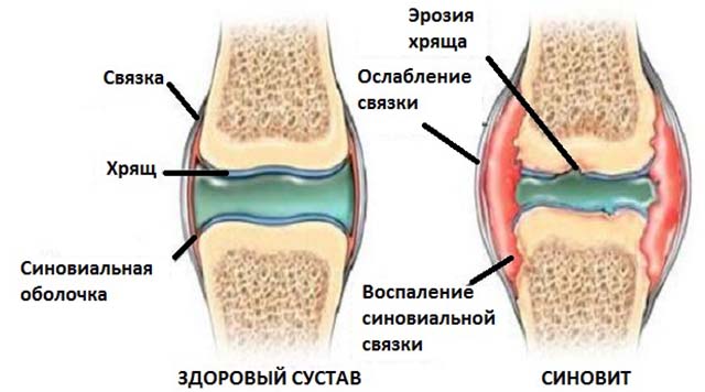Отекла правая нога ниже колена причины лечение thumbnail