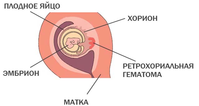 Ретрохориальная гематома