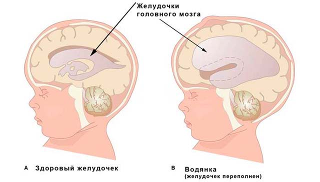 Желудочки головного мозга