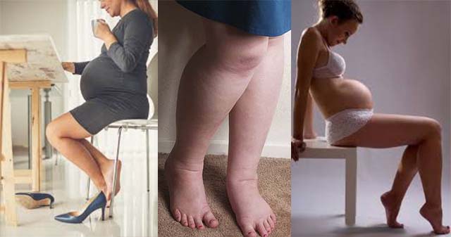 Отечность ног причины и лечение у беременных thumbnail