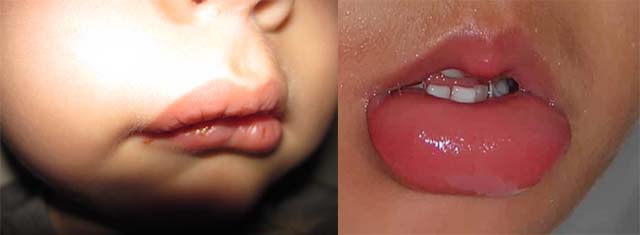 Что делать если у ребенка опухла верхняя губа