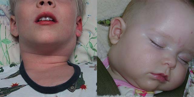 Воспаленные лимфатические узлы на шее у детей