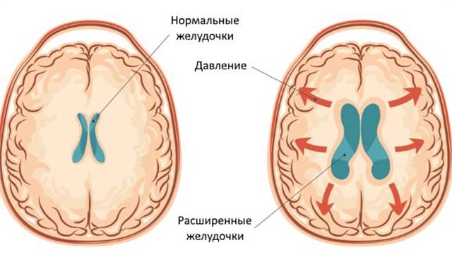 Расширенные желудочки головного мозга