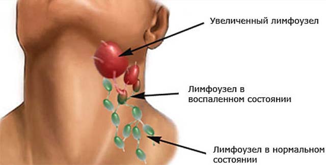 Как вылечить воспаленный лимфоузел на шее у ребенка thumbnail
