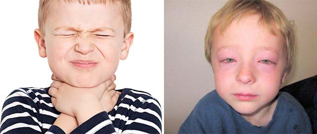 Аллергический отек гортани у детей лечение thumbnail