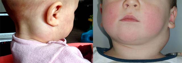 Вылечить воспаление лимфоузла на шее у ребенка thumbnail