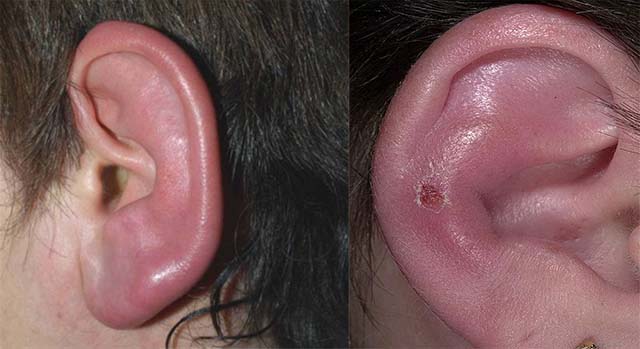 Воспаление ушного канала внешнего уха