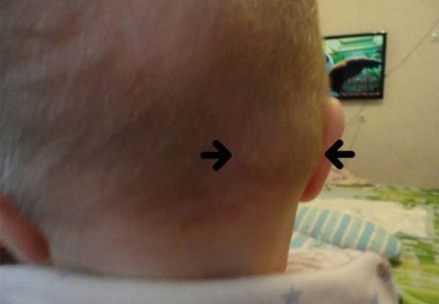Лимфоузел на шеи у ребенка не болит температуры нет thumbnail