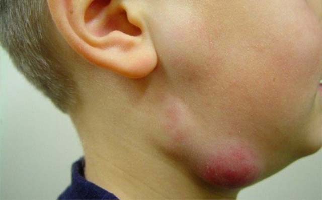 Воспаленный лимфоузел у ребенка на шее лечение в домашних условиях thumbnail
