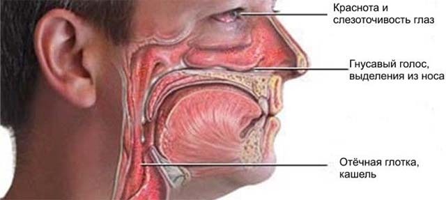 Лечение отека слизистой носа у детей народными средствами thumbnail