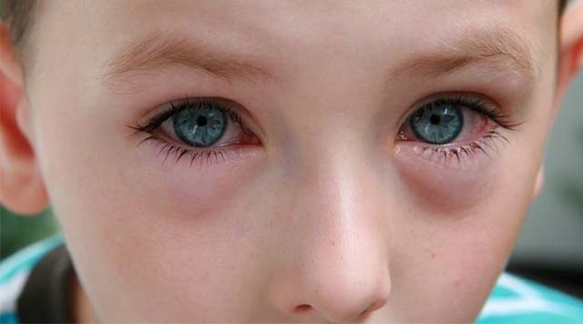 Аллергия глаз