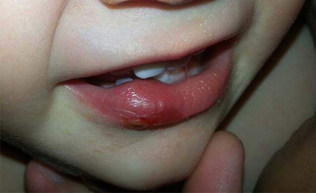 Ребенок прикусил нижнюю губу