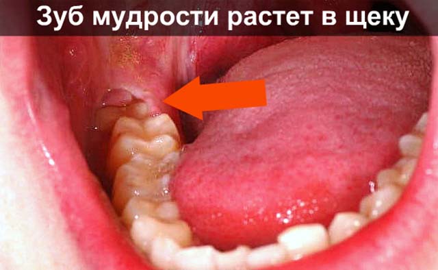 После лечения зуба опухла щека чем лечить thumbnail