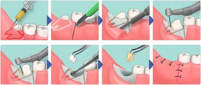 Чем снять отек лица после лечения зуба thumbnail