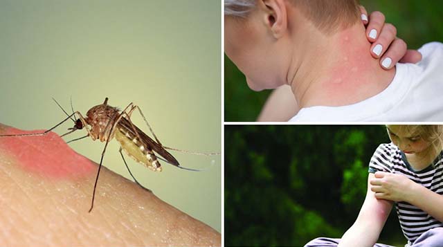Укус комара отек у ребенка что делать