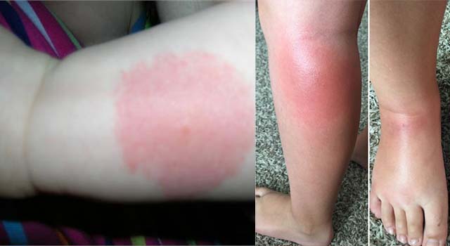 Аллергический отек на ногах