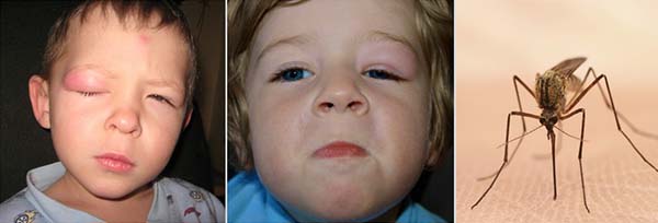 Отек верхнего века одного глаза у ребенка причины и лечение thumbnail